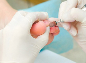 Инновационная методика лечения вросшего ногтя